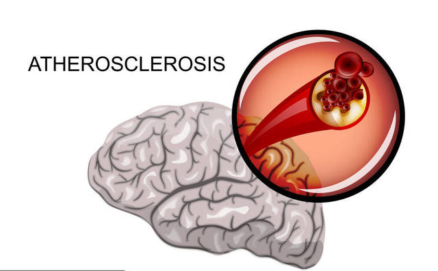 腦血管硬化早期會(huì)有這四種表現(xiàn)，醫(yī)生說(shuō)這三類人一定要重視！