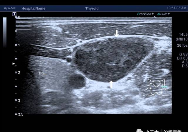 揭秘：淋巴結(jié)總是令人困惑的存在：Castleman Disease