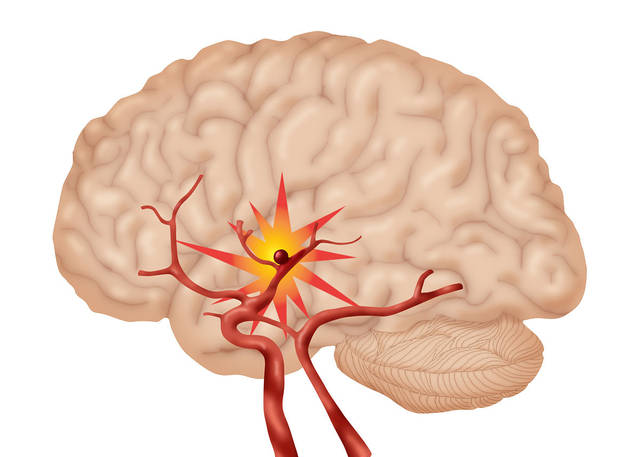 腦血管硬化早期會(huì)有這四種表現(xiàn)，醫(yī)生說這三類人一定要重視！