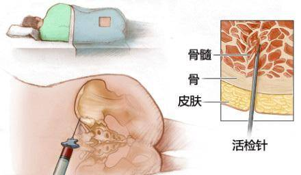 骨髓穿刺術(shù)操作規(guī)范及訓(xùn)練模型