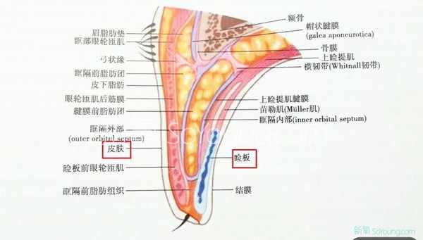 埋線雙眼皮必看掃盲帖