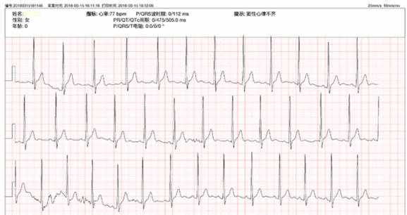 原創(chuàng) 體檢出竇性心律不齊，該怎么辦？