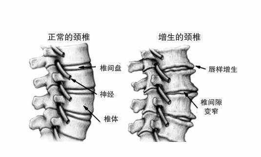 頸椎病引起的頭暈，要注意了，可以試試這6種方法！