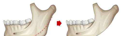 削骨 面部削骨能讓一個人變化多大？