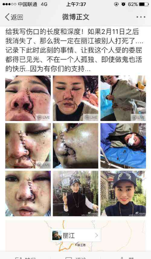 麗江毀容 麗江惡性毀容搶劫案女孩琳噠是我資料照片 講述事情經(jīng)過