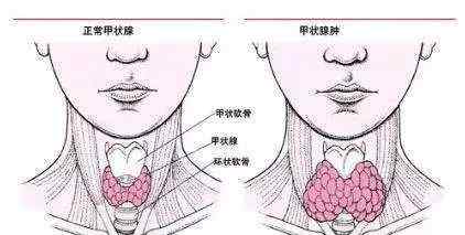 得甲狀腺結(jié)節(jié) 為什么很多人都有甲狀腺結(jié)節(jié)?