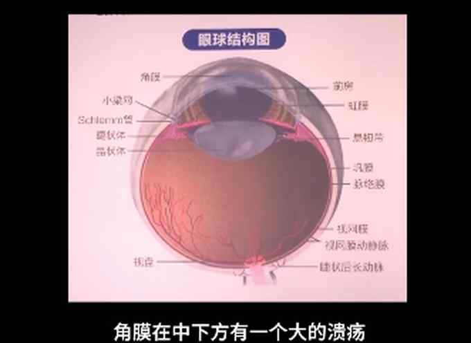 10歲男孩感染真菌眼角膜潰爛 醫(yī)生：孩子經(jīng)常摳腳后揉眼睛