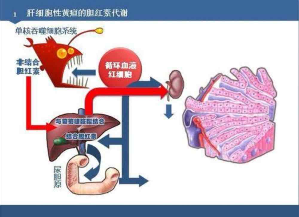 肝細(xì)胞性黃疸 肝細(xì)胞性黃疸