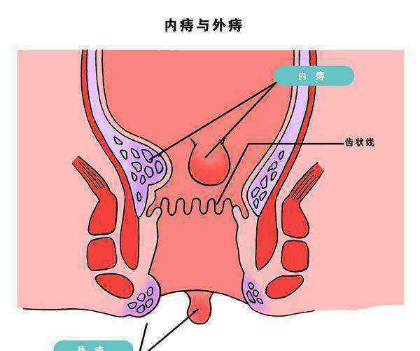 我被女s強(qiáng)制取精經(jīng)歷 女生經(jīng)歷痔瘡手術(shù)，是一種怎樣的體驗(yàn)！