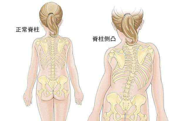 脊柱的四個(gè)生理彎曲 脊柱生理彎曲是怎么回事