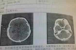 男子被吃腦蟲入侵 男子被罕見的“吃腦蟲”入侵 十幾天后病逝