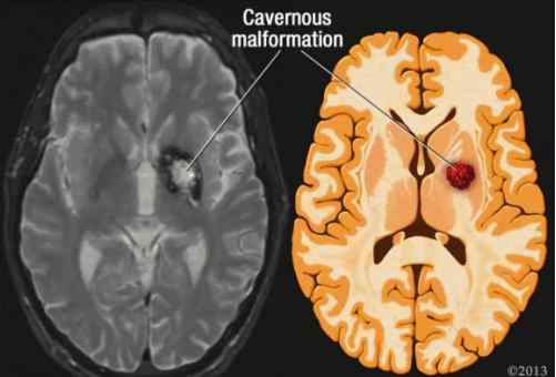 海綿狀血管瘤嚴(yán)重嗎 顱內(nèi)海綿狀血管瘤有什么特點(diǎn)，可能比想象中更嚴(yán)重，建議大家重視