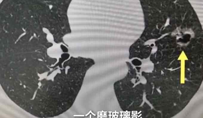 女子長期吸同事二手煙肺部長腫塊 網(wǎng)友：室內(nèi)抽煙的人太自私