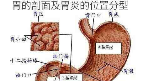 慢性非萎縮性胃炎伴糜爛 胃鏡顯示慢性非萎縮性胃炎伴糜爛，該怎么調(diào)養(yǎng)呢？