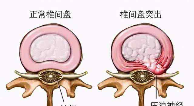 椎間盤突出的保守治療 腰椎間盤突出80%-90%不需要手術(shù)，可以這樣治....