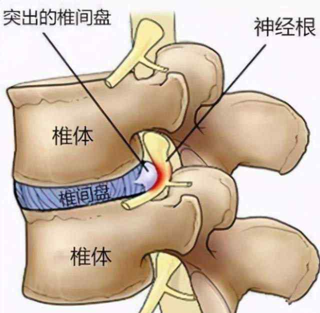 椎間盤突出的保守治療 腰椎間盤突出80%-90%不需要手術(shù)，可以這樣治....