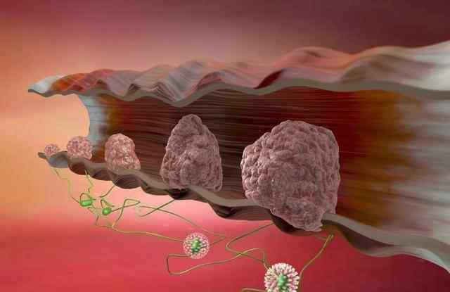 直腸癌的癥狀和前兆 腸癌的癥狀和前兆是怎樣的？醫(yī)生的答案來(lái)了