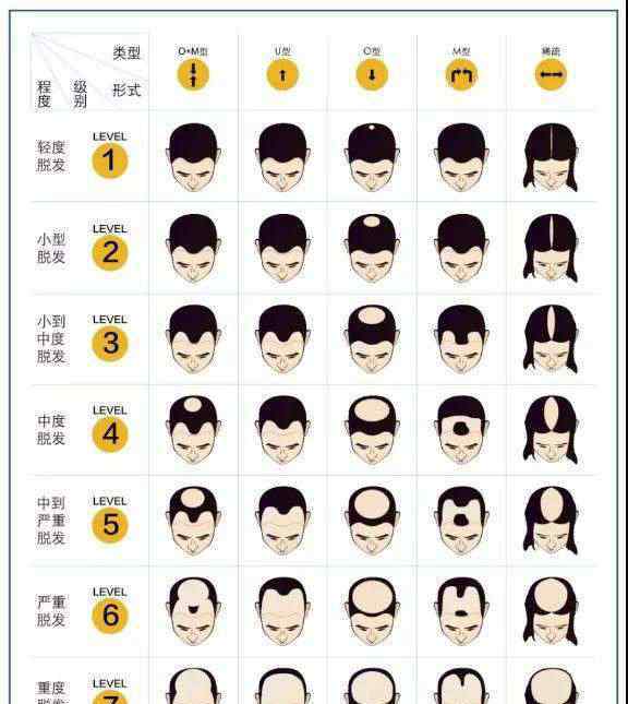 植發(fā)新聞 中國有2.5億人脫發(fā)，有些“植發(fā)醫(yī)生”花幾千就能賺幾百萬