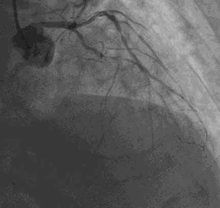 pci 冠狀動脈介入手術（PCI）