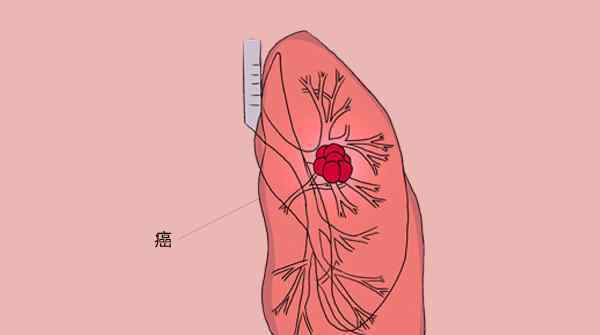 肺癌咳嗽特點(diǎn) 咳嗽是小??？呼吸科醫(yī)生：滿足3個(gè)特點(diǎn)，也許是肺癌的征兆