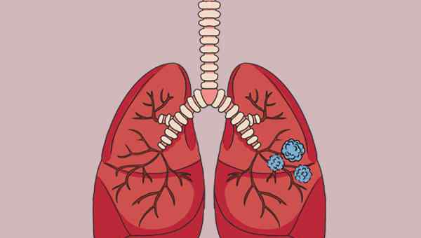 肺部小結(jié)節(jié)會消失嗎 肺結(jié)節(jié)會不會自動消失？查出肺結(jié)節(jié)，到底該如何處理？