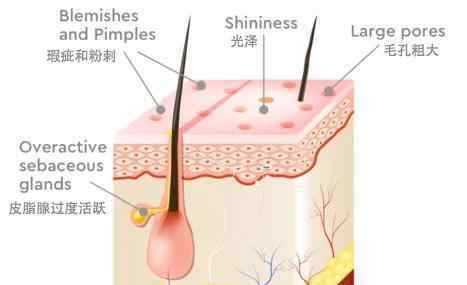 皮膚油脂分泌旺盛怎么辦 皮膚愛出油怎么辦？ 為什么低碳飲食可以逆轉(zhuǎn)“大油皮”？