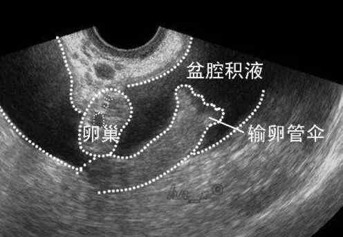 病理性盆腔積液 盆腔有積液是不是大問題？需要馬上治療嗎？