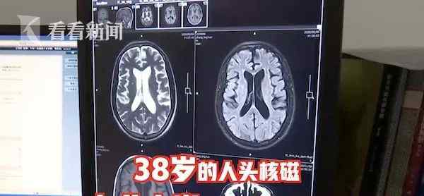 北京藏醫(yī)院男性?？?38歲男子被查出“癡呆晚期”？罪魁禍首讓人意想不到