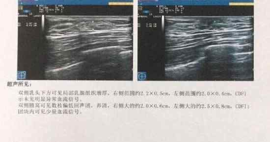 健身3個(gè)月胸部發(fā)育是什么原因