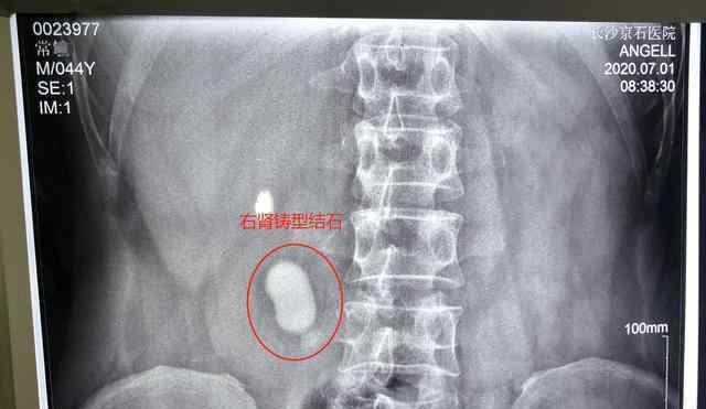 男子患腎結(jié)石沒在意 8年后到醫(yī)院檢查急忙手術(shù)