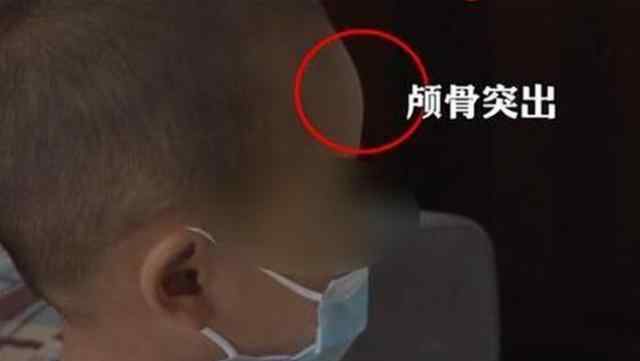 三鹿嬰幼兒奶粉事件 “大頭娃娃”再現(xiàn)，堪比12年前的三鹿奶粉事件，網(wǎng)友：實(shí)在無(wú)法原諒