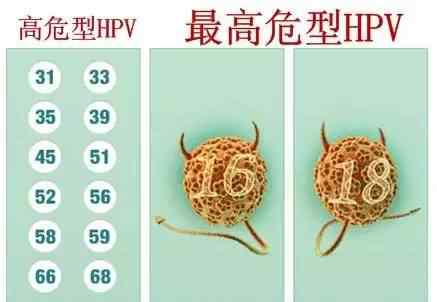 宮頸hpv52陽性普遍嗎 HPV陽性，不要盲目恐慌！