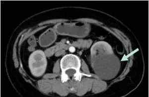 左腎囊腫是怎么回事 【醫(yī)學(xué)科普】檢查發(fā)現(xiàn)了腎囊腫該怎么辦？