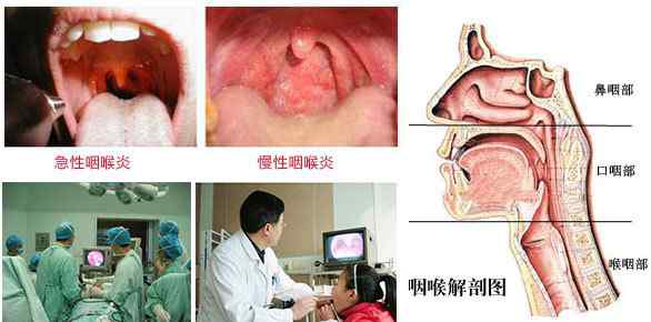 慢性咽炎霧化治療 慢性咽炎很頑固，千萬(wàn)不要大意