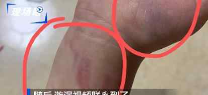 小學(xué)生未完成作業(yè)手腕被打淤青 怎么處理的