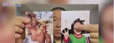 撫順6歲被虐女童體表重傷2級 孩子目前情況如何