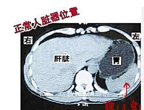 脾腫大 脾臟科普系列（一）--------脾大不是脾氣大