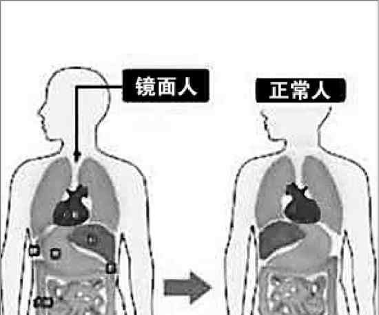 溫州男子五臟六腑反著長 發(fā)生概率只有百萬分之一