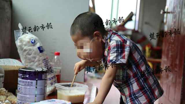 5歲男孩臉?biāo)坪玉R 無(wú)法呼吸不能用口吃飯