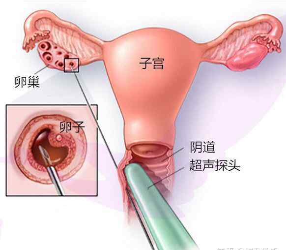 取卵子過(guò)程視頻播放 卵子是怎么取出來(lái)的？揭秘取卵過(guò)程