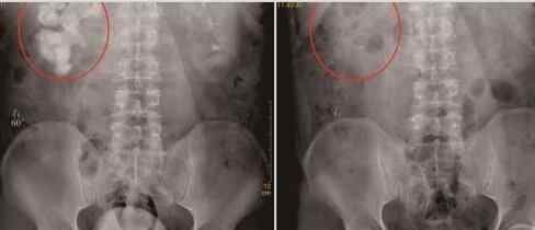 男子結(jié)石長滿腎臟 右腎功能僅剩2成左右