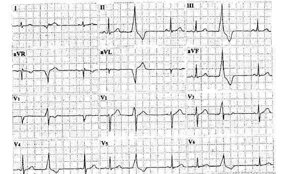 室性早搏的心電圖特點 Rosenbaum 室性早搏