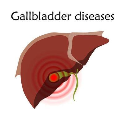 膽囊息肉如何治療 膽囊息肉有哪些治療方法？看看這篇文章，或許對您有所幫助