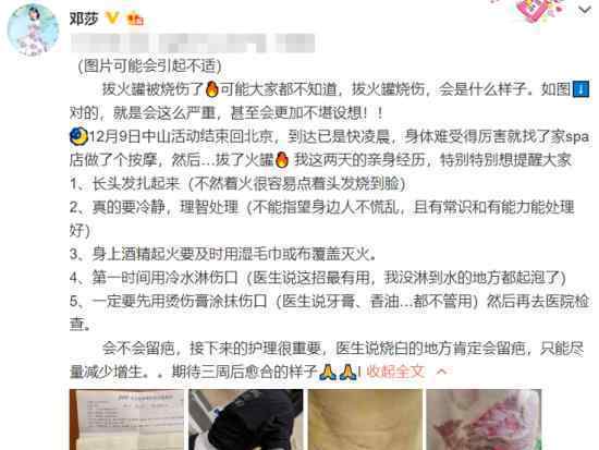 鄧莎拔火罐被燒傷 是怎么回事鄧莎個(gè)人資料介紹