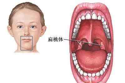 小孩子扁桃體肥大怎么辦 扁桃體肥大，菡仁堂小兒推拿告訴您不開刀的解決方法