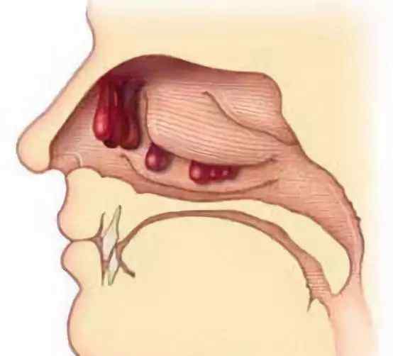 鼻息肉是怎么引起的 鼻息肉的危害那么多，那會癌變嗎？該怎么預防呢？
