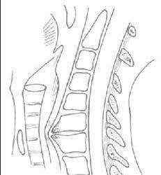 頸椎壓迫食管早期表現(xiàn) 關(guān)于食管壓迫型頸椎病的簡單介紹