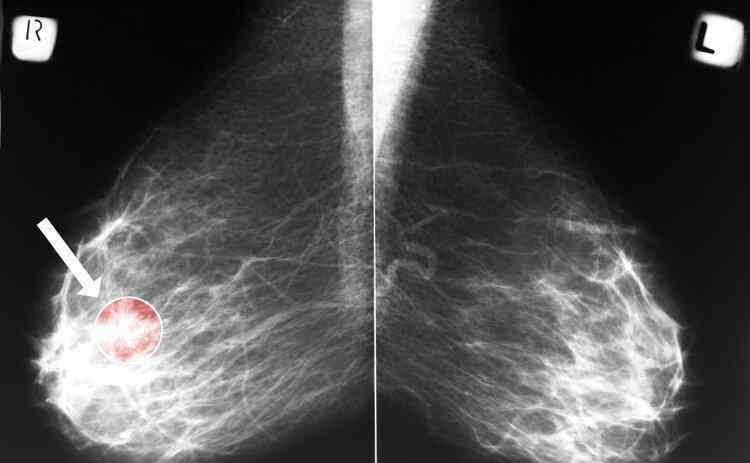 帶癌生存40年 癌癥熬過5年生存期就算治愈？她的腫瘤突然“爆發(fā)”，全身轉(zhuǎn)移…