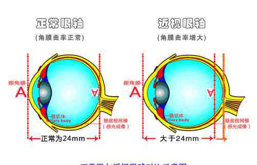 假性近視和真近視有什么不同 假性近視與真性近視有什么區(qū)別？學(xué)會(huì)看視力和度數(shù)你就懂了！