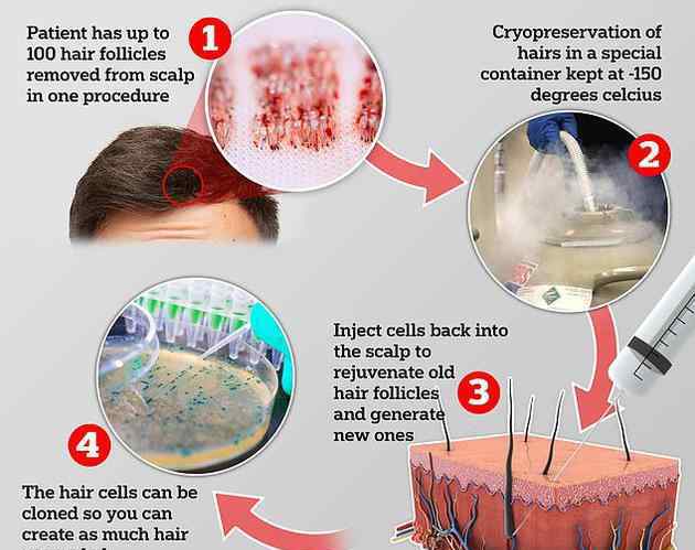 英國推出“克隆”毛囊技術(shù) 復(fù)制毛囊細(xì)胞并對(duì)你進(jìn)行頭皮注射